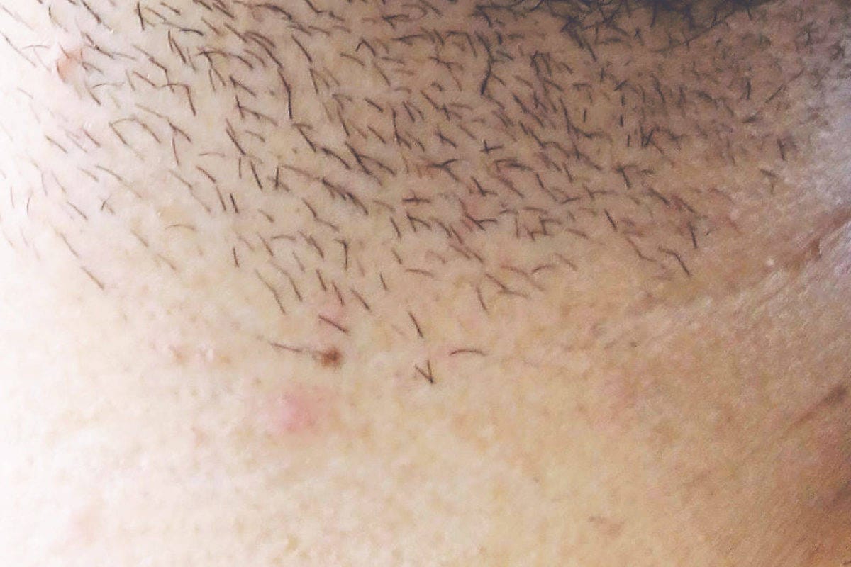Foliculitis
